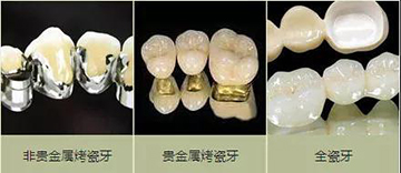 牙冠多少钱一颗2021价格表(图1)